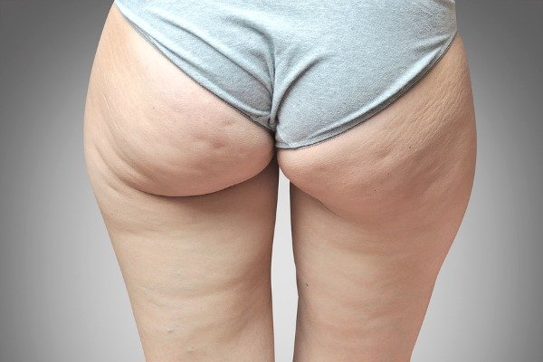Cellulite